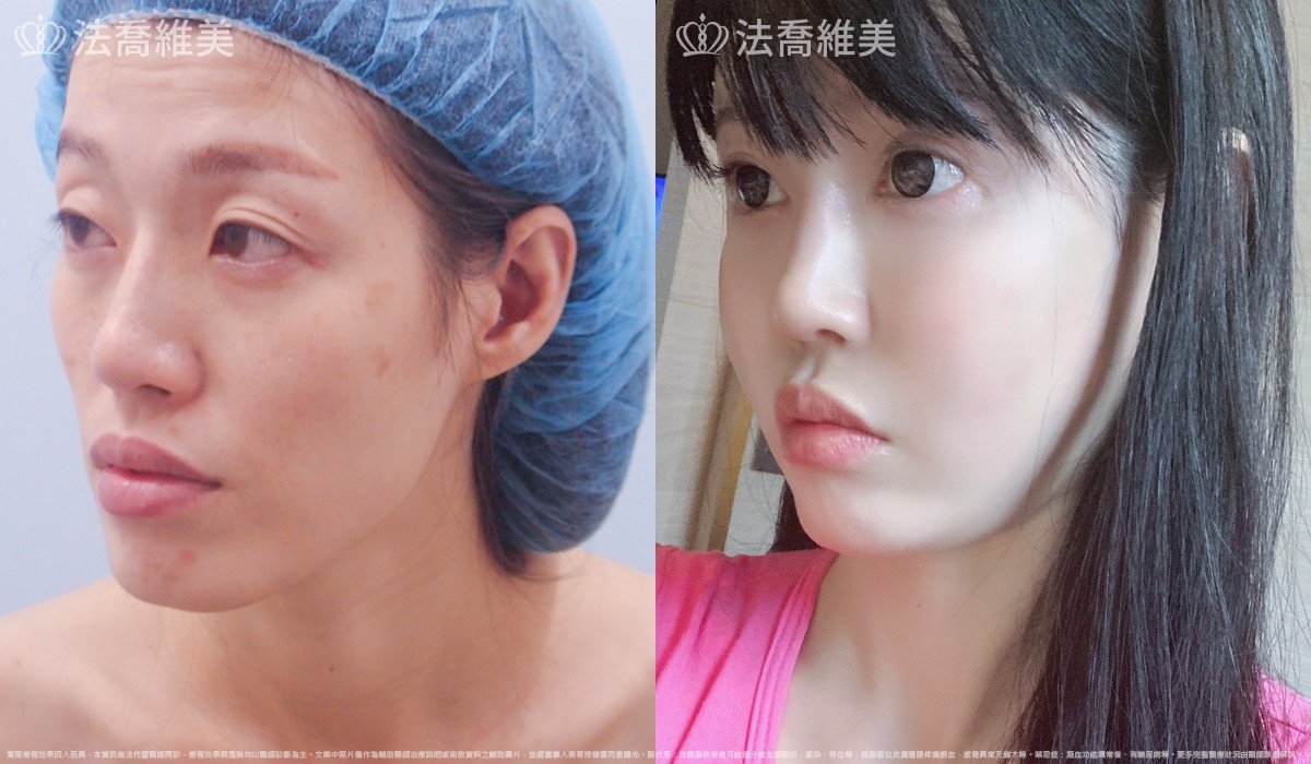 法喬醫美診所,邱浚彥,自體豐全臉