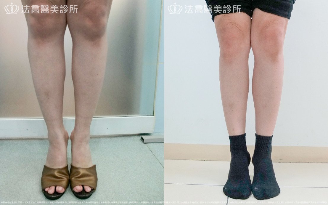 法喬醫美診所,邱浚彥,小腿神經截斷術