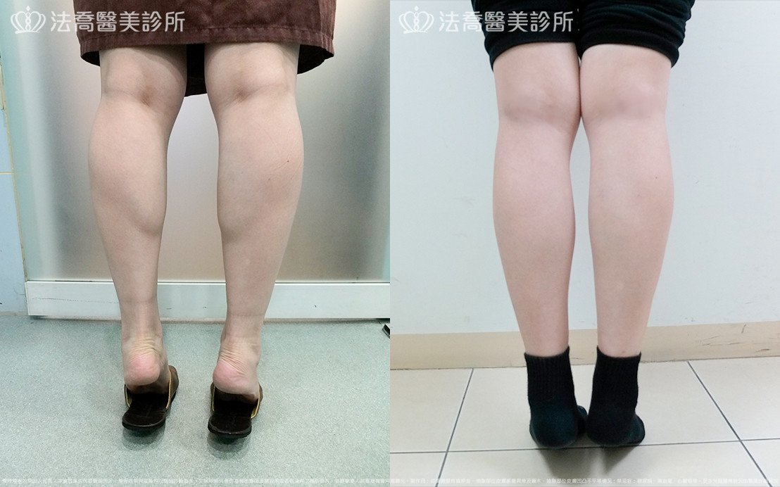 法喬醫美診所,邱浚彥,小腿神經截斷術