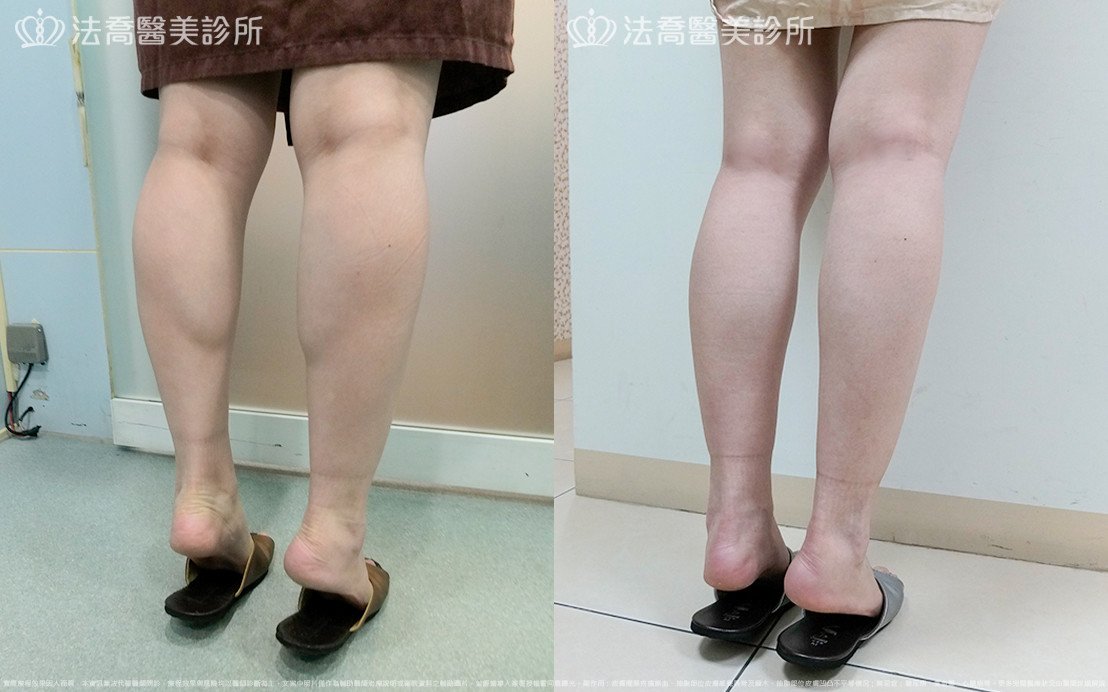 法喬醫美診所,邱浚彥,小腿神經截斷術