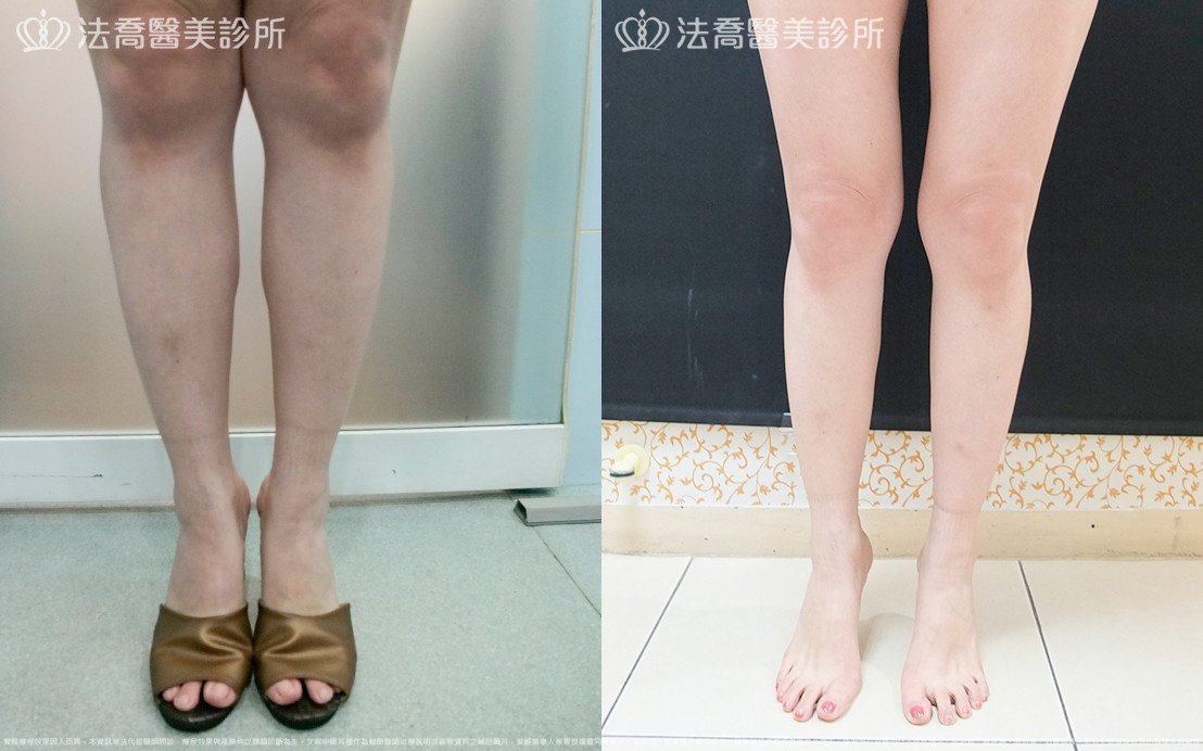 法喬醫美診所,邱浚彥,小腿神經截斷術