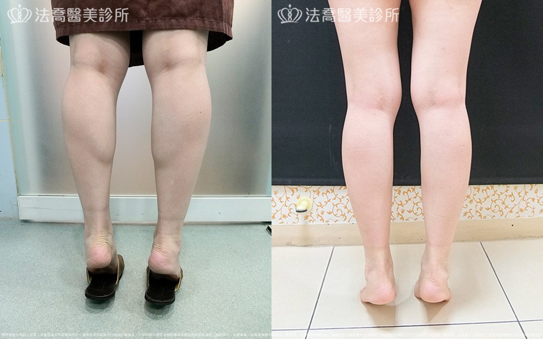 法喬醫美診所,邱浚彥,小腿神經截斷術