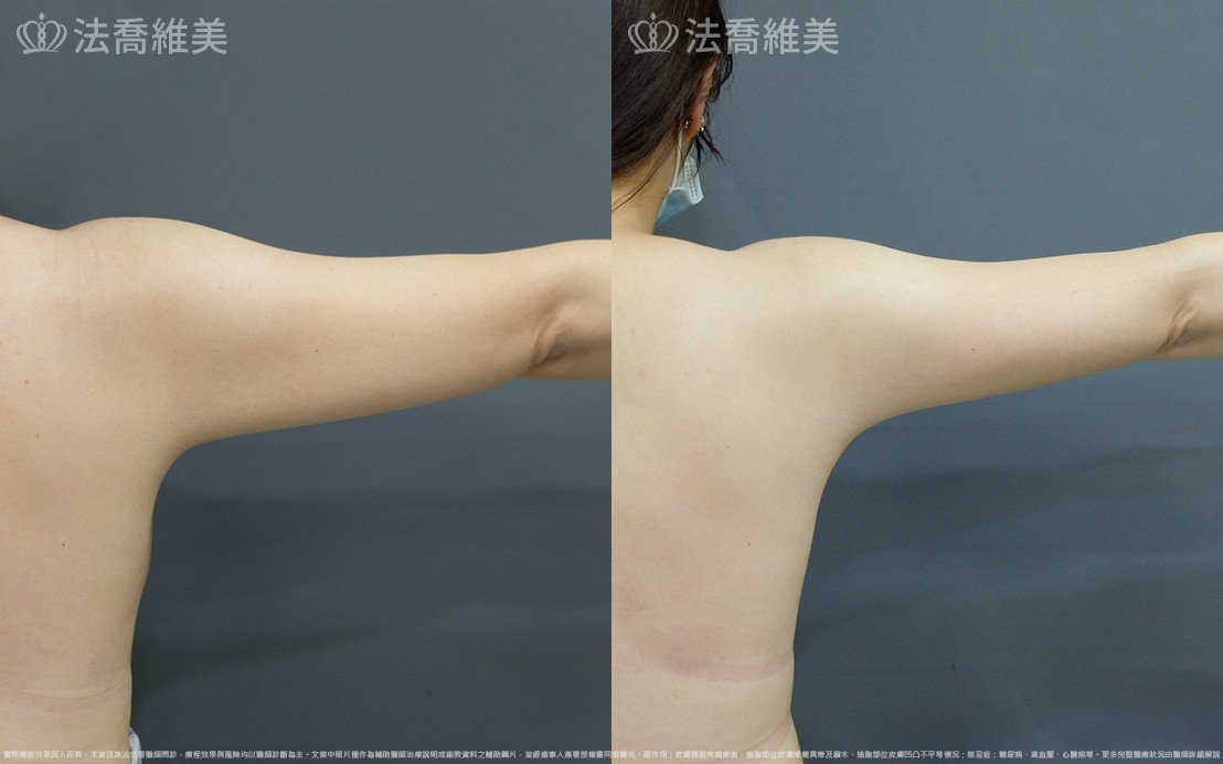 法喬醫美診所,邱浚彥,威塑蝴蝶袖