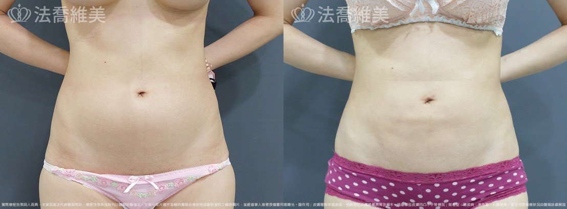 腹部環抽