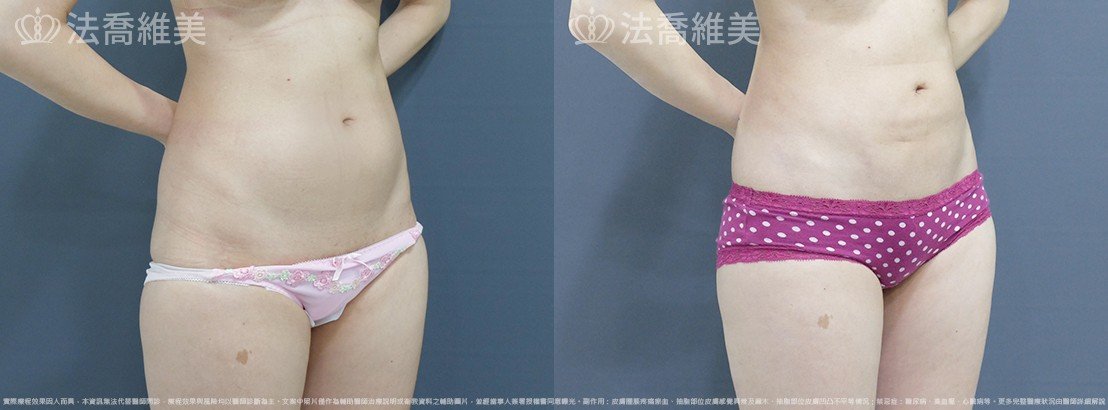 腰側抽脂