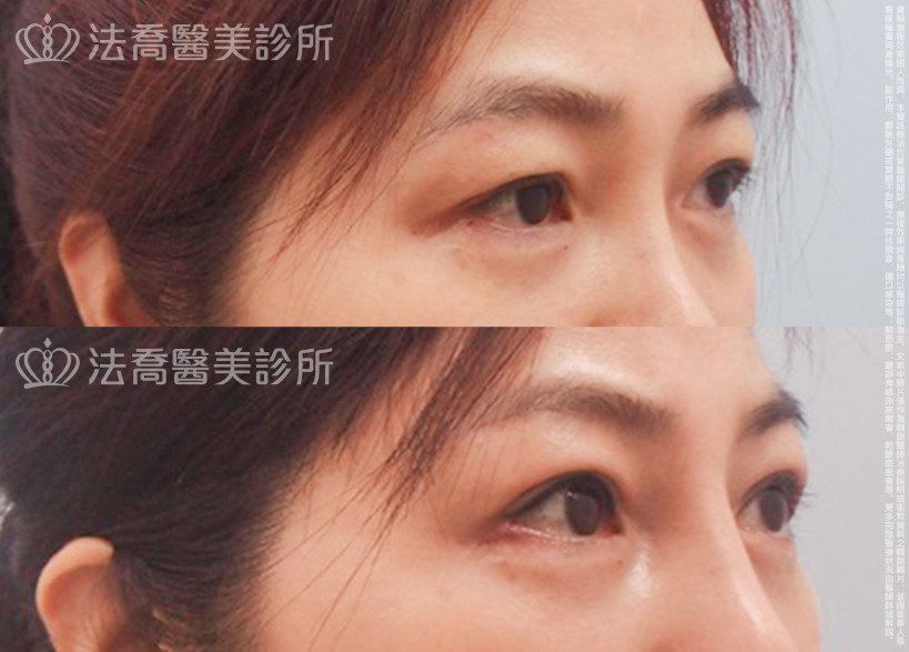 法喬醫美診所,邱浚彥,割雙眼皮,開眼頭,開眼尾