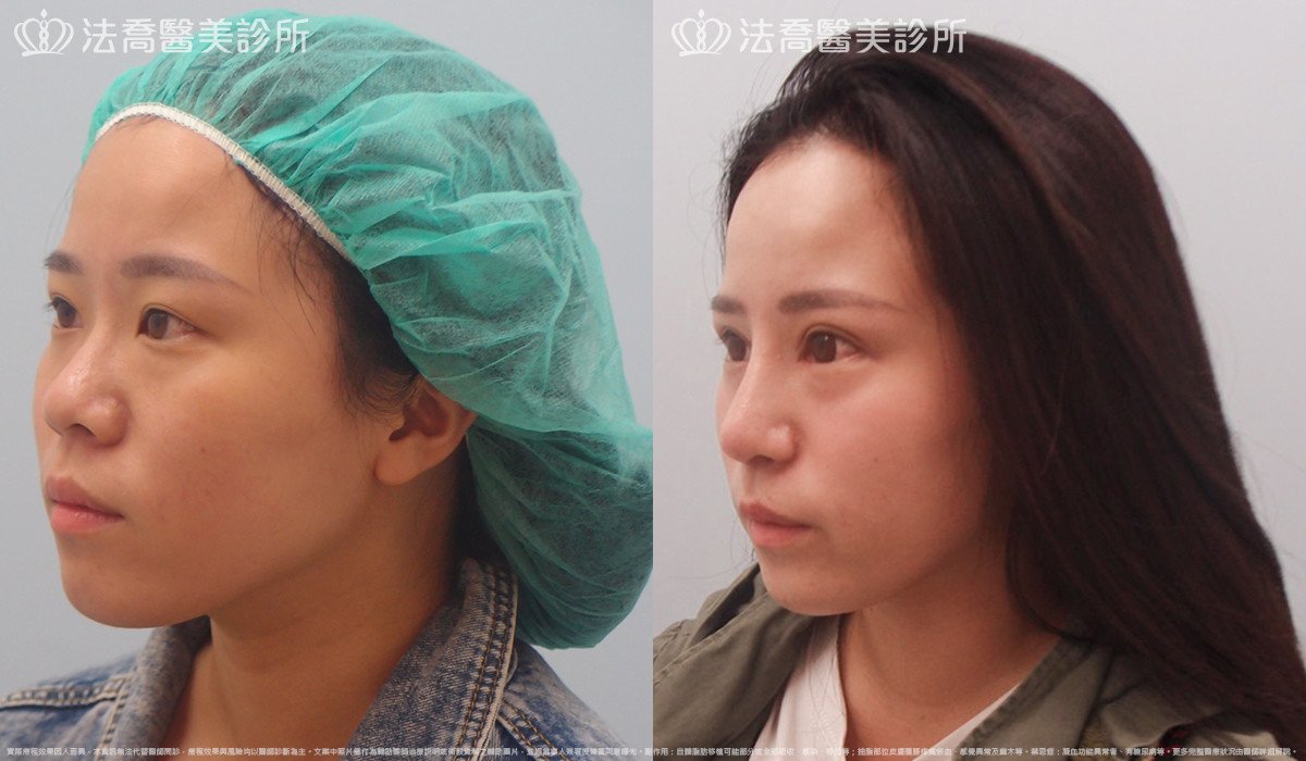 法喬醫美診所,邱浚彥,自體肋骨隆鼻