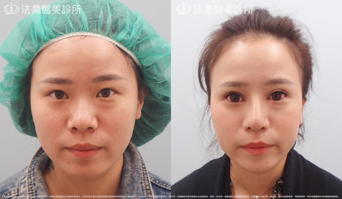 法喬醫美診所,邱浚彥,自體肋骨隆鼻
