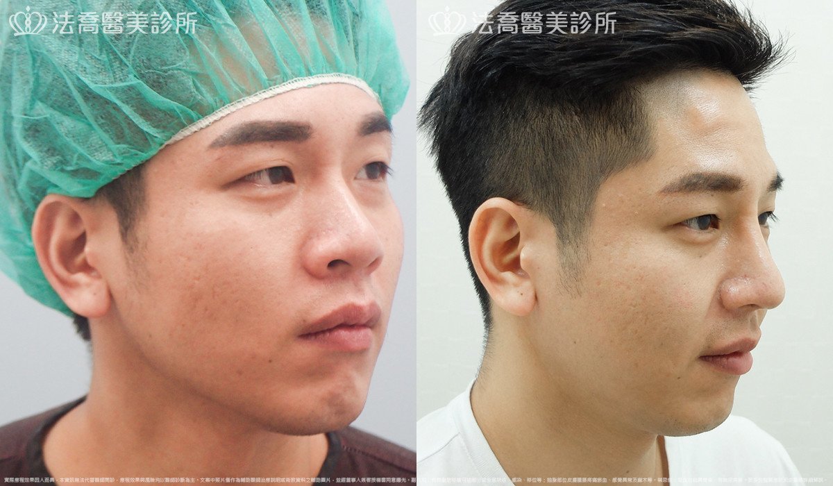 法喬醫美診所,邱浚彥,自體肋骨隆鼻