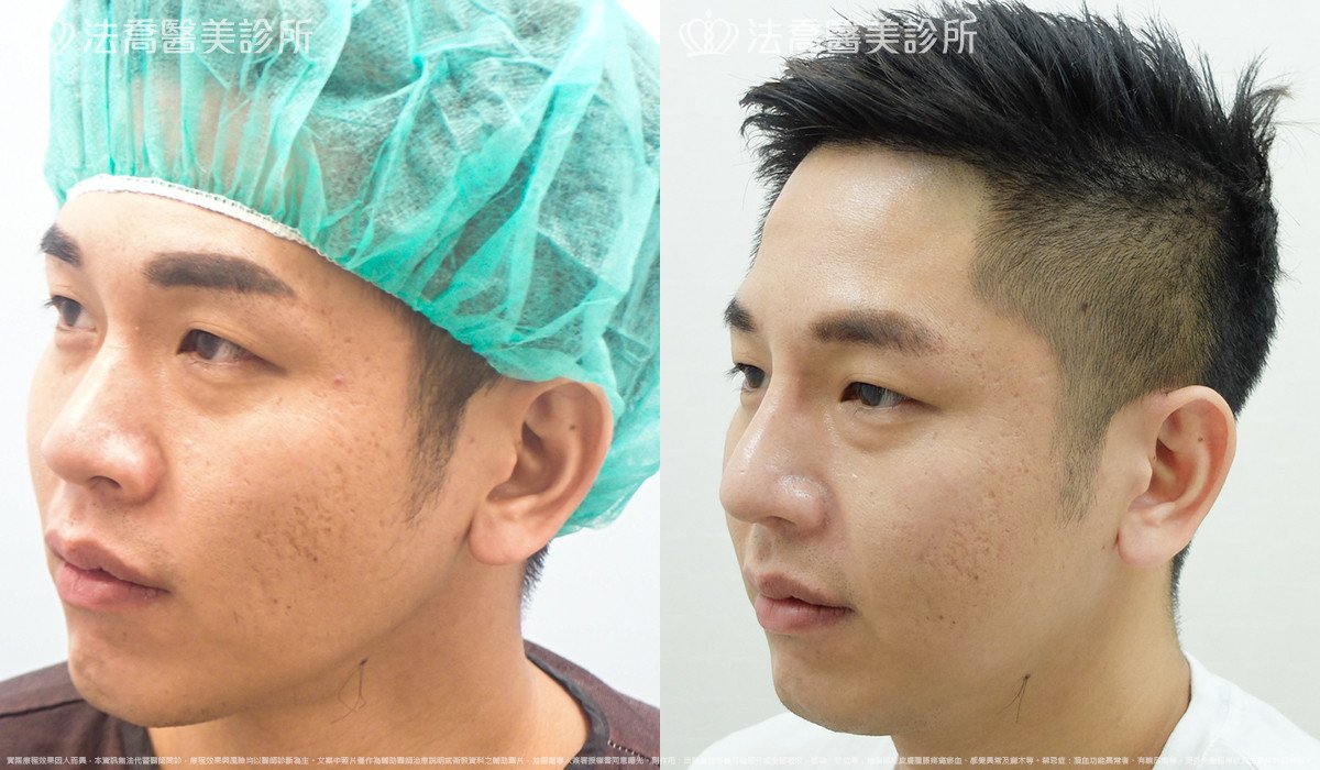 法喬醫美診所,邱浚彥,自體肋骨隆鼻