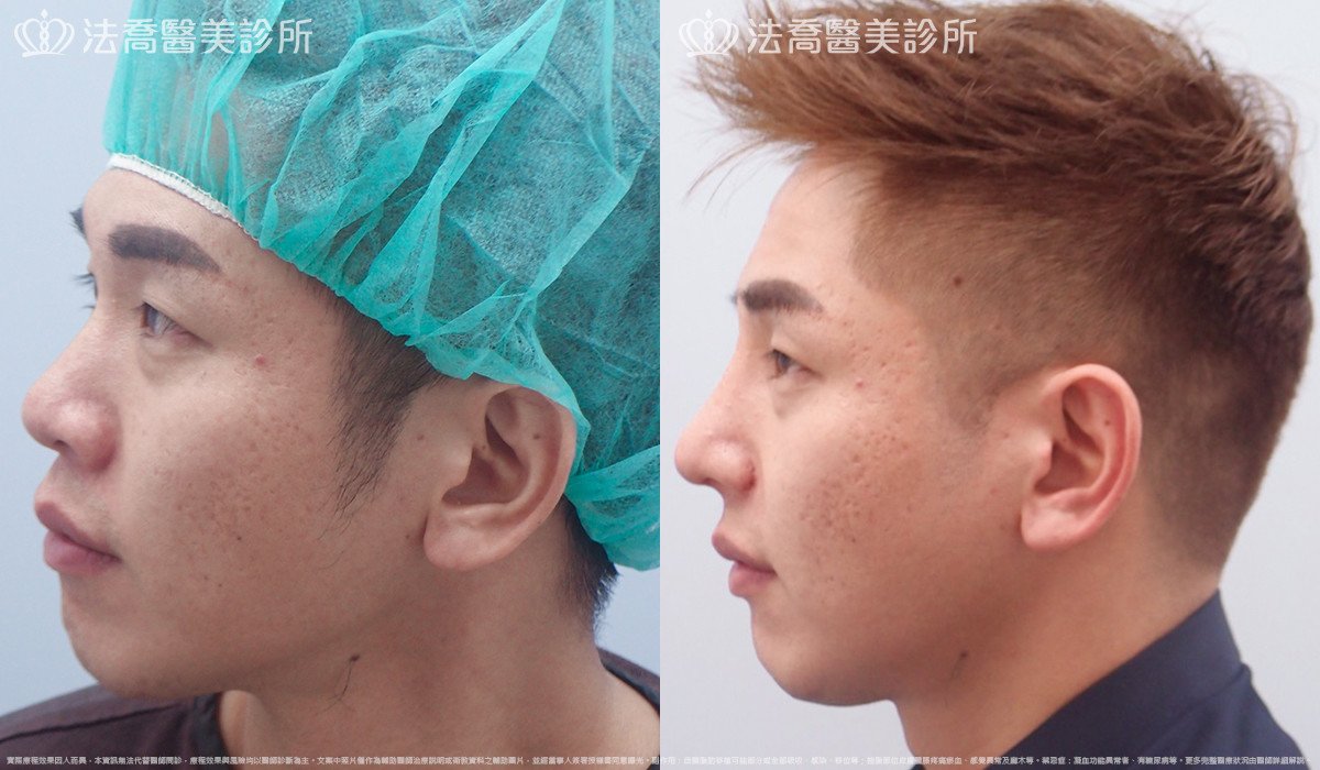 法喬醫美診所,邱浚彥,自體肋骨隆鼻