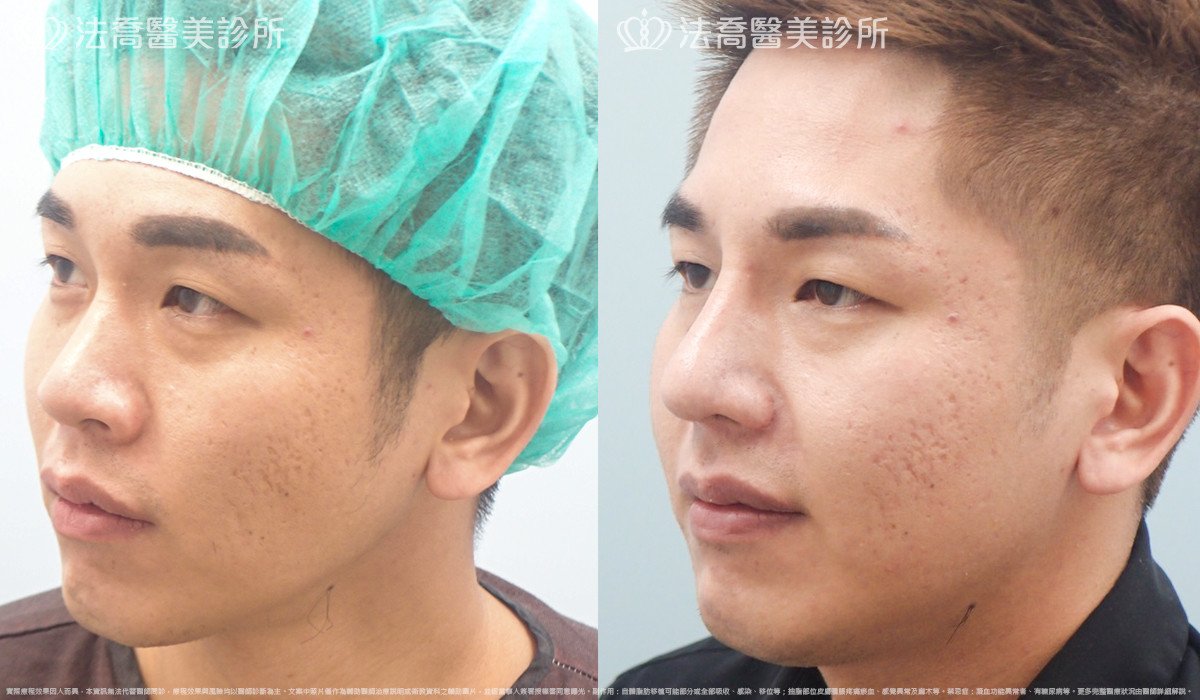 法喬醫美診所,邱浚彥,自體肋骨隆鼻