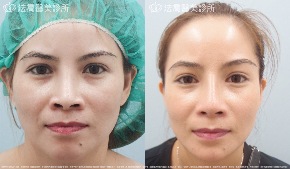 法喬醫美診所,邱浚彥,自體肋骨隆鼻,鼻截骨,縮鼻翼