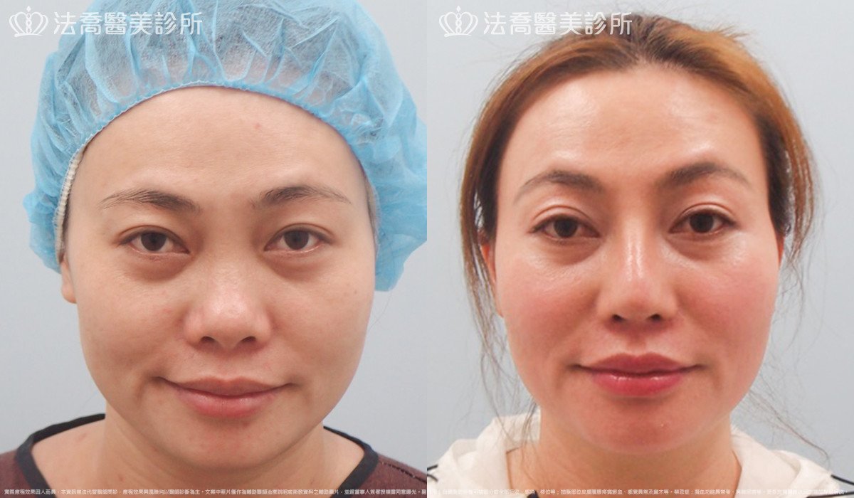 法喬醫美診所,邱浚彥,自體肋骨隆鼻