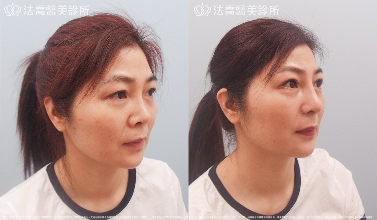 法喬醫美診所,邱浚彥,自體肋骨隆鼻