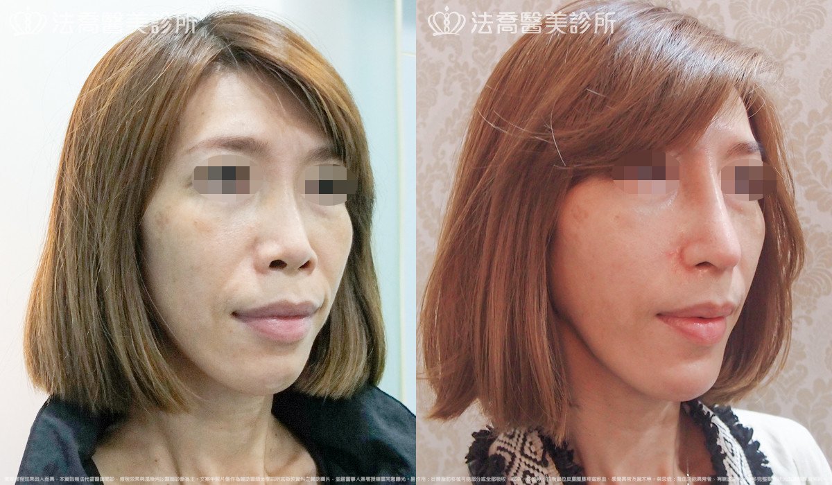 法喬醫美診所,邱浚彥,人工骨墊下巴