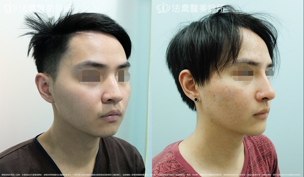 法喬醫美診所,邱浚彥,自體肋骨隆鼻