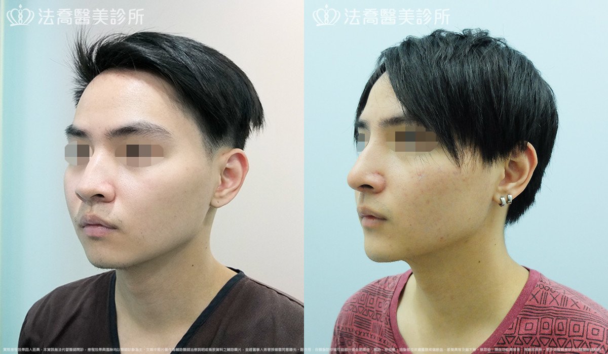法喬醫美診所,邱浚彥,自體肋骨隆鼻