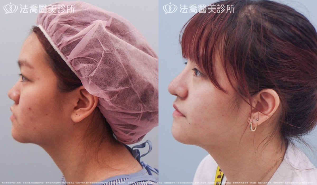 法喬醫美診所,邱浚彥,自體肋骨隆鼻