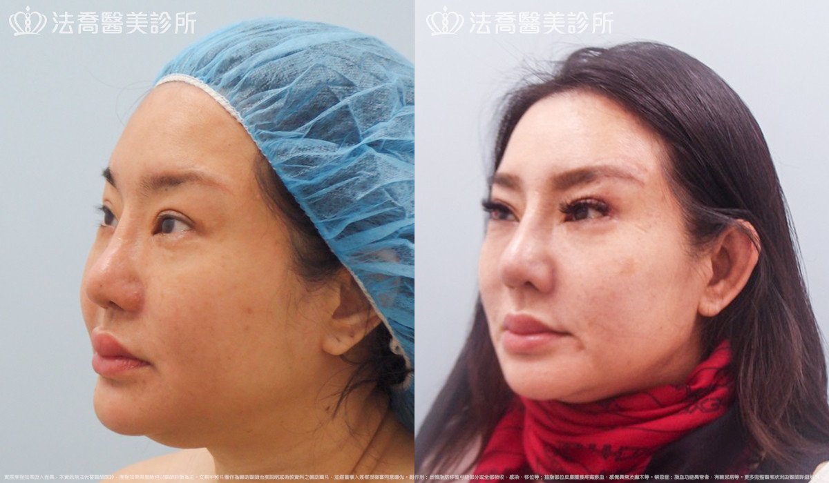 法喬醫美診所,邱浚彥,自體肋骨隆鼻
