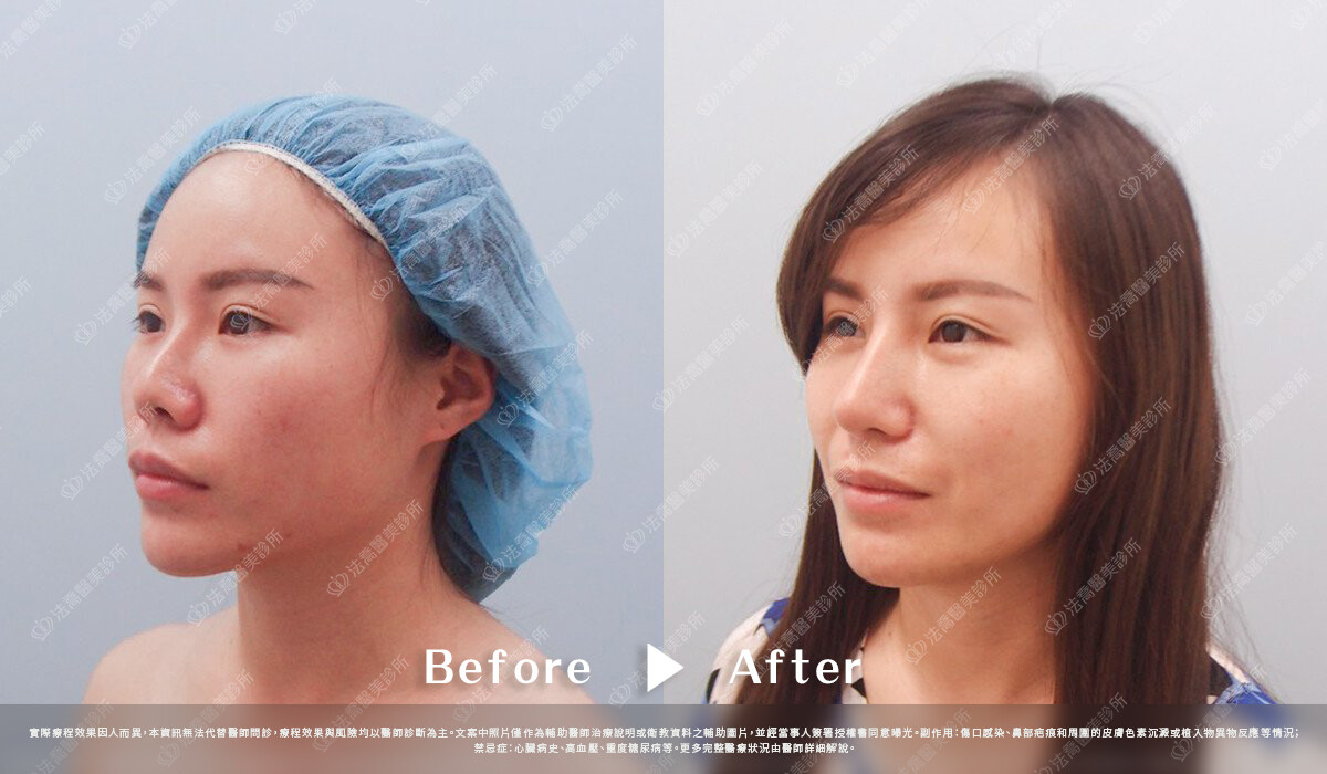 法喬醫美診所,邱浚彥,自體肋骨隆鼻