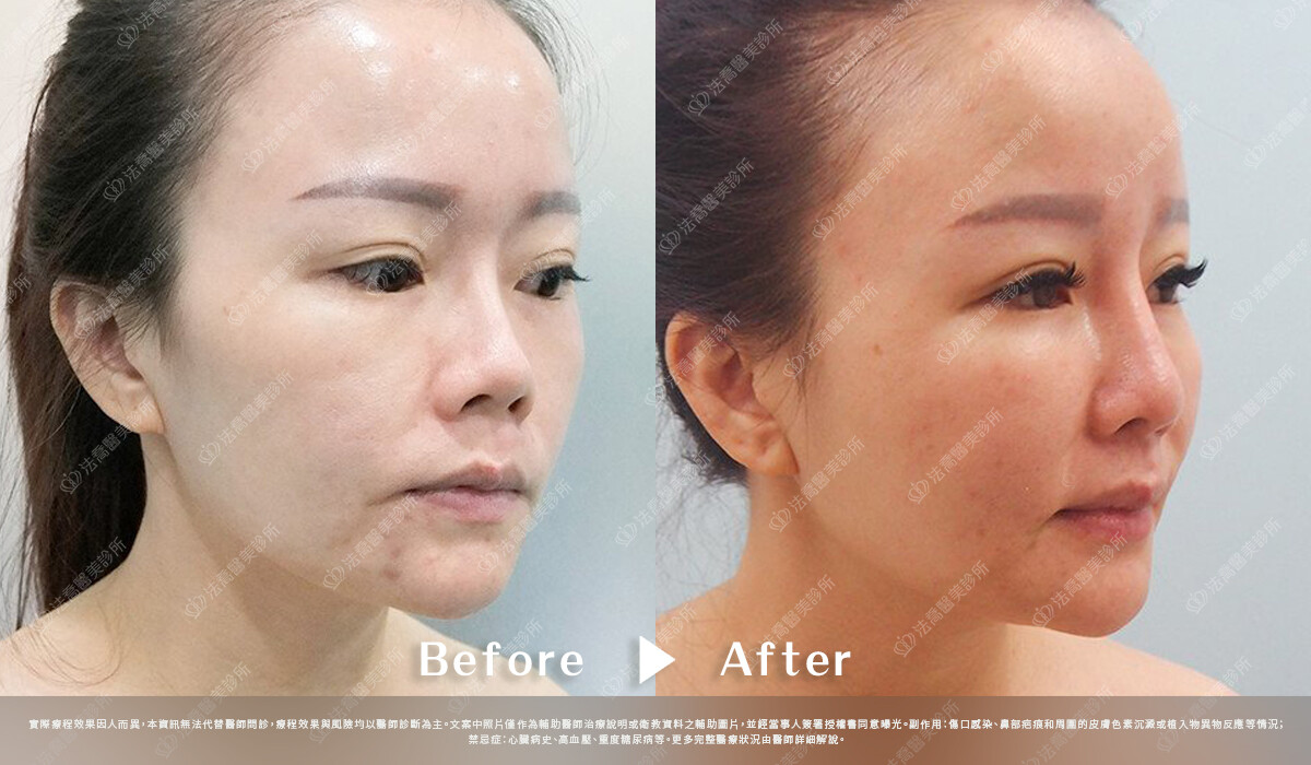 法喬醫美診所,邱浚彥,自體肋骨隆鼻