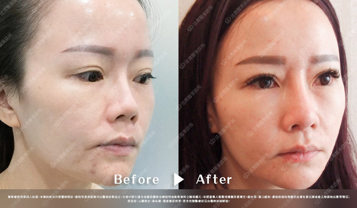 法喬醫美診所,邱浚彥,自體肋骨隆鼻