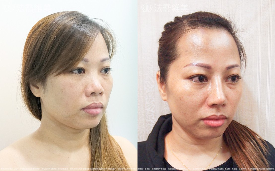 法喬醫美診所,邱浚彥,自體肋骨隆鼻