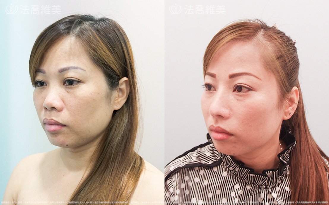 法喬醫美診所,邱浚彥,自體肋骨隆鼻