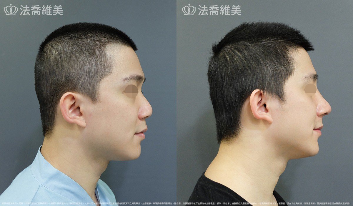 自體肋骨隆鼻,法喬醫美診所,邱浚彥