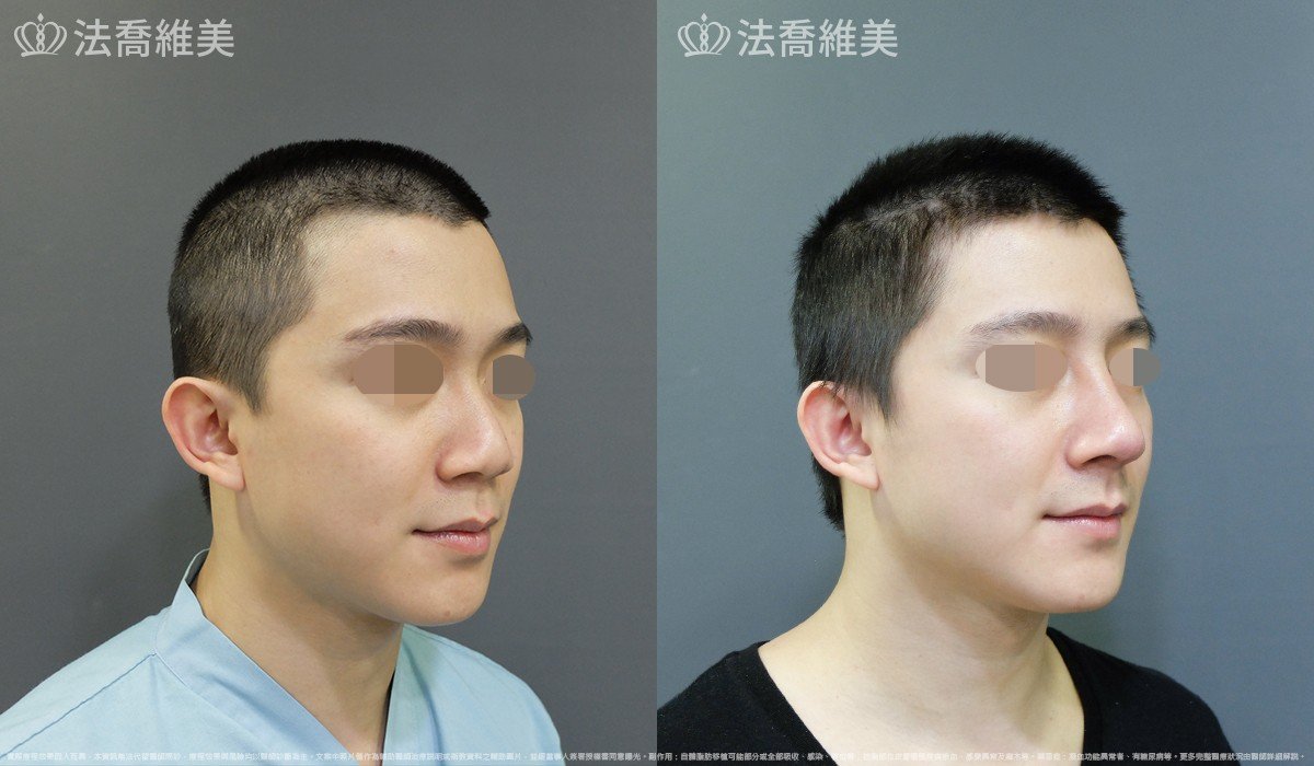 自體肋骨隆鼻,法喬醫美診所,邱浚彥
