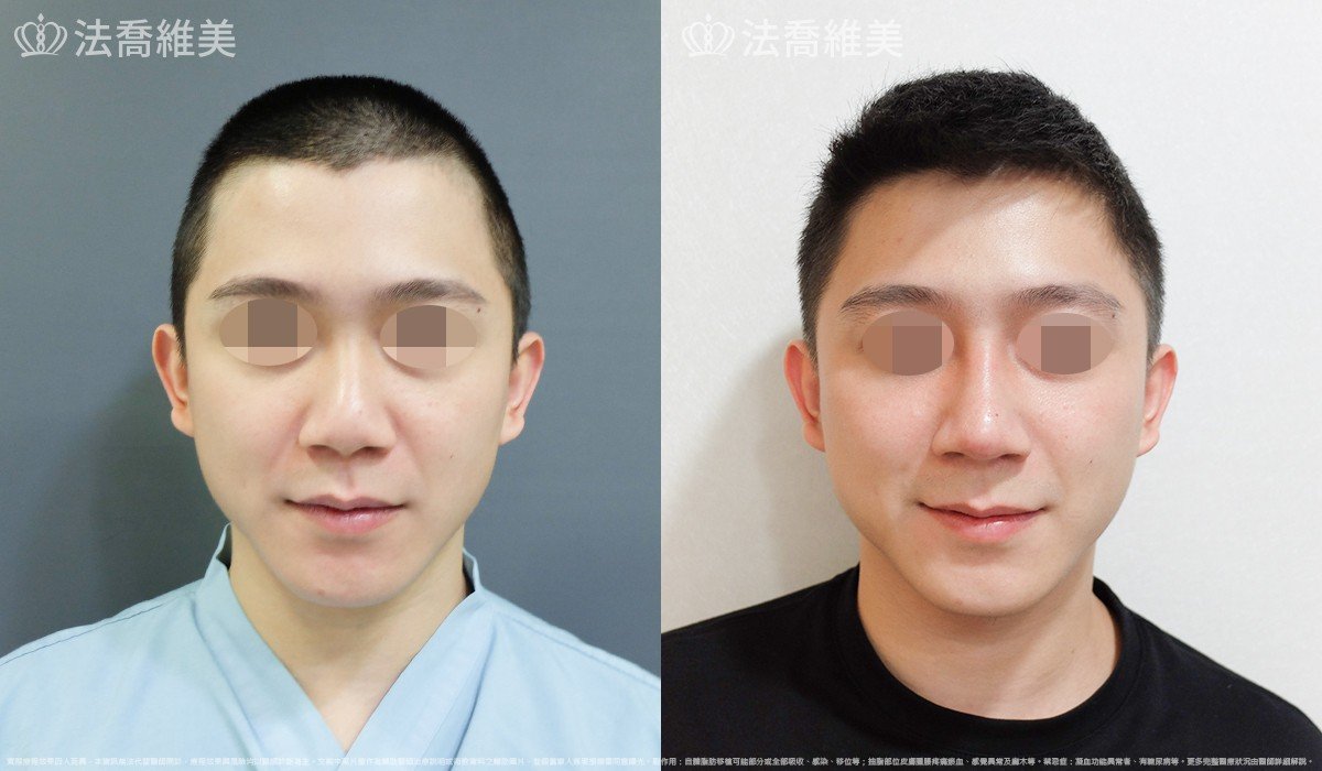自體肋骨隆鼻,法喬醫美診所,邱浚彥