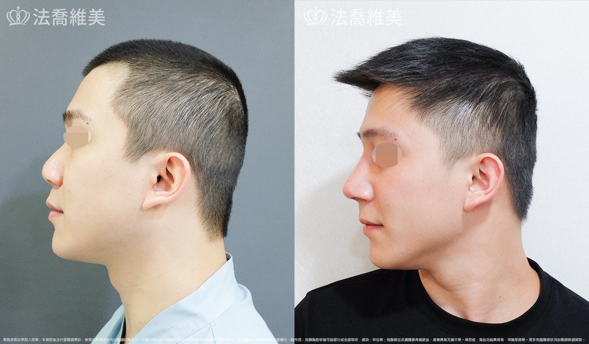 自體肋骨隆鼻,法喬醫美診所,邱浚彥