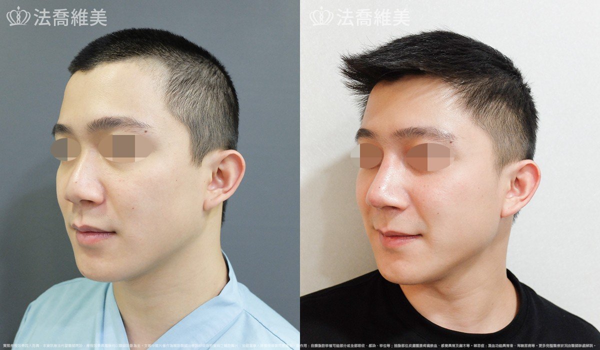自體肋骨隆鼻,法喬醫美診所,邱浚彥