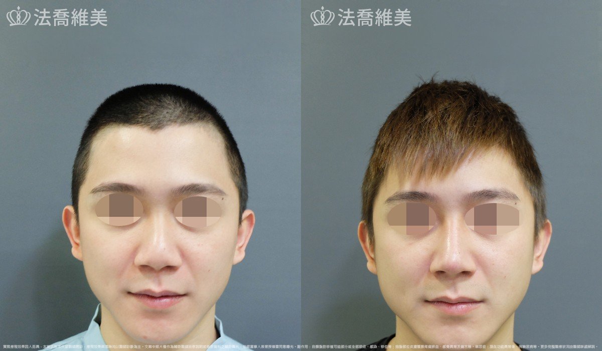 自體肋骨隆鼻,法喬醫美診所,邱浚彥