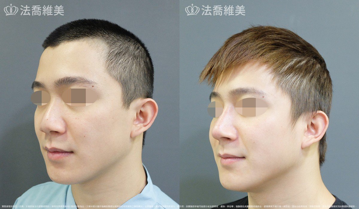 自體肋骨隆鼻,法喬醫美診所,邱浚彥
