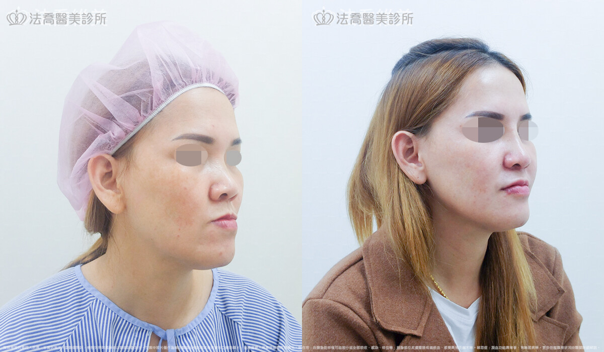 自體肋骨隆鼻