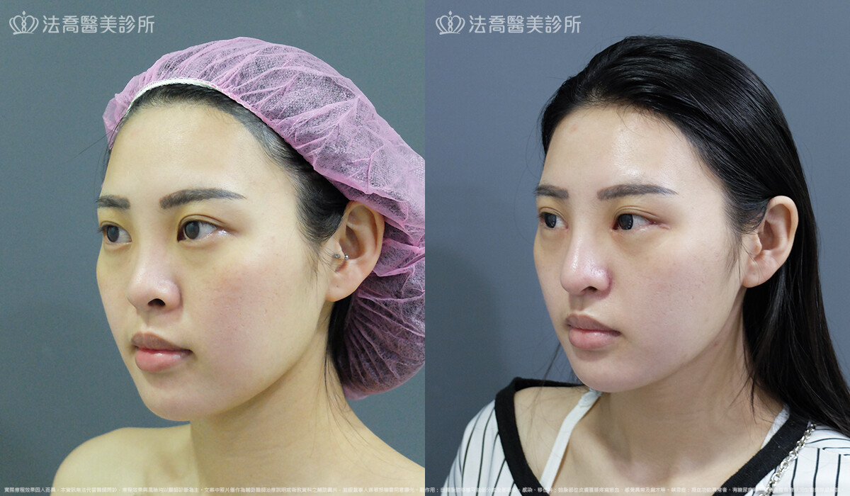 自體肋骨隆鼻