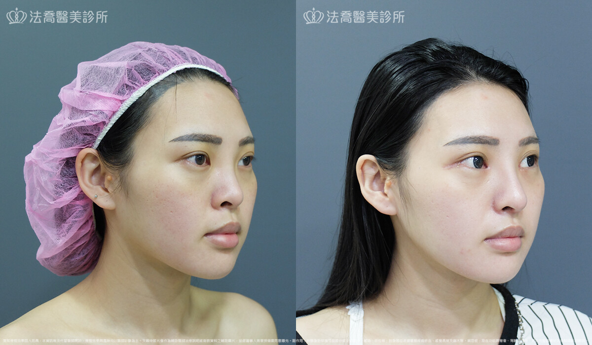 縮鼻翼