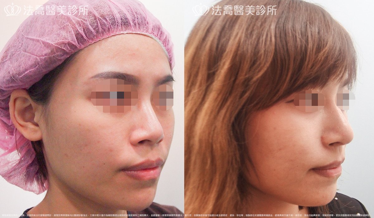 goretex隆鼻,法喬醫美診所,邱浚彥