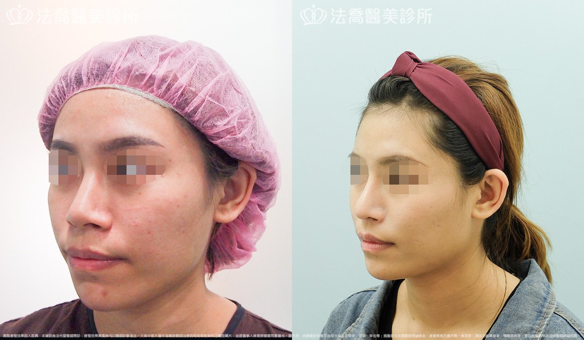 goretex隆鼻,法喬醫美診所,邱浚彥