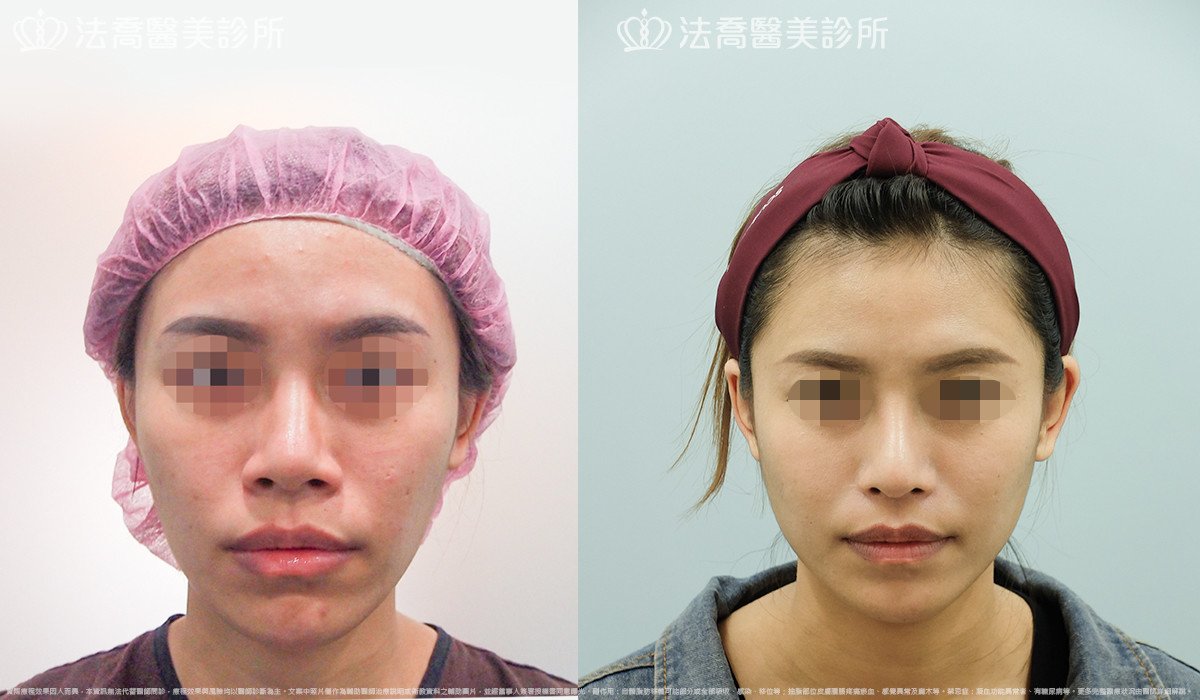 goretex隆鼻,法喬醫美診所,邱浚彥