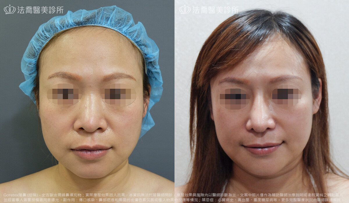 法喬醫美診所,邱浚彥,goretex隆鼻