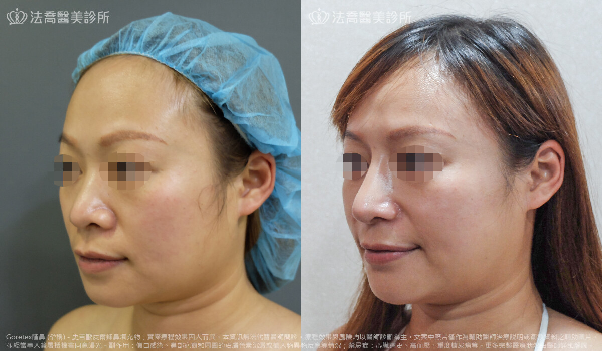 法喬醫美診所,邱浚彥,goretex隆鼻
