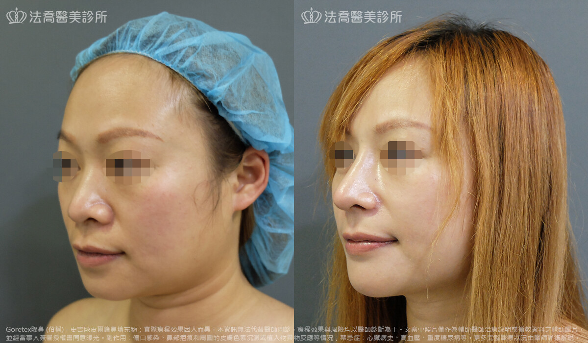 法喬醫美診所,邱浚彥,goretex隆鼻