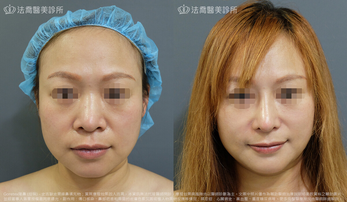 法喬醫美診所,邱浚彥,goretex隆鼻