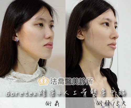 喬喬 Goretex隆鼻 人工骨墊鼻中膈 法喬維美醫美診所 台北 台中 高雄
