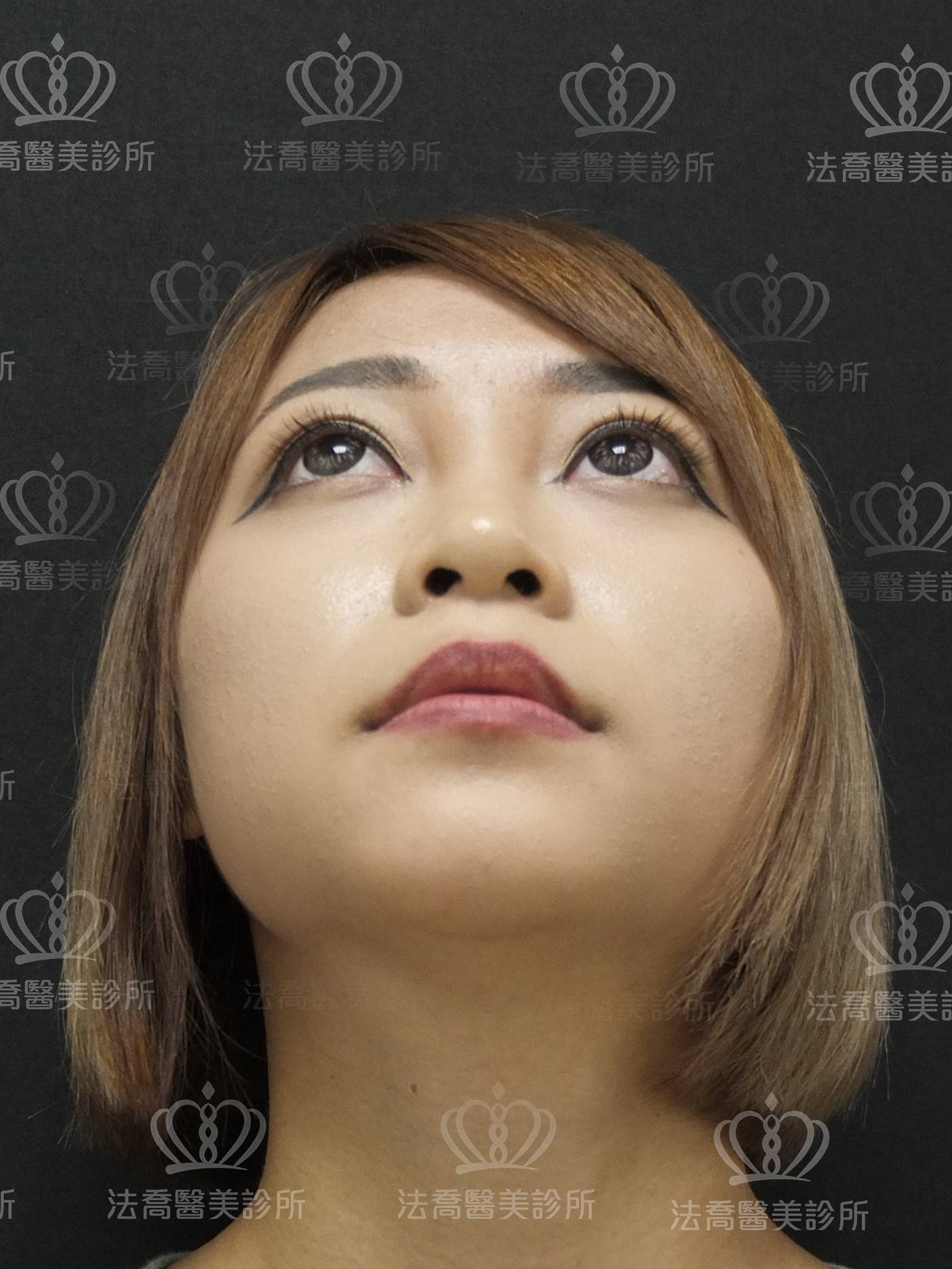 法喬醫美診所-Goretex案例