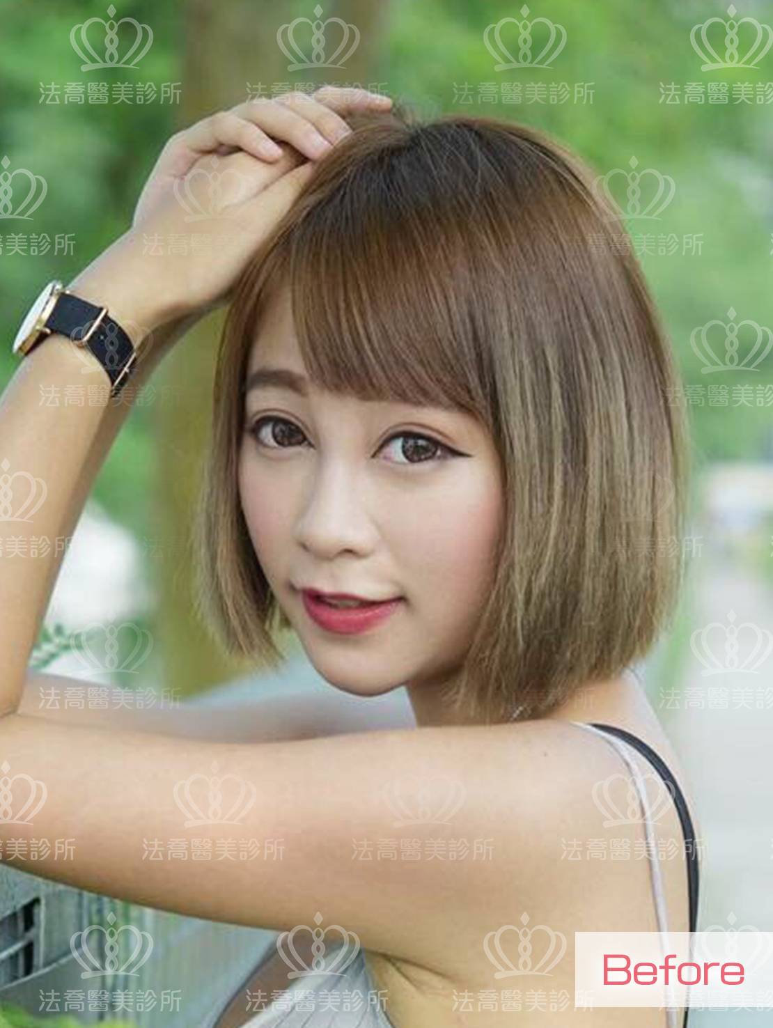 法喬醫美-Goretex隆鼻案例