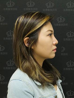 法喬醫美診所客製化骨水泥墊下巴